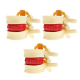 Maxbell 3X Human Spine Lumbar Intervertebral Disc Protrusion Model Magnification 2x