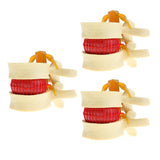 Maxbell 3X Human Spine Lumbar Intervertebral Disc Protrusion Model Magnification 2x