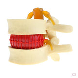 Maxbell 3X Human Spine Lumbar Intervertebral Disc Protrusion Model Magnification 2x