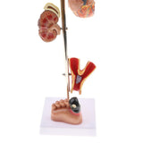 Maxbell Removable 5 Parts Pathological Diabetes 5 Parts (Eye ball, Heart, ney, Vessel, Foot) Model School Teaching Display - Aladdin Shoppers