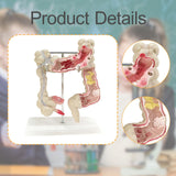 Maxbell Human Colon Model Realistic Colon Pathology Model for Lab Training Classroom