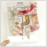 Maxbell Human Colon Model Realistic Colon Pathology Model for Lab Training Classroom