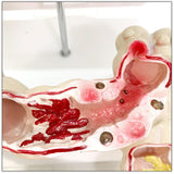 Maxbell Human Colon Model Realistic Colon Pathology Model for Lab Training Classroom