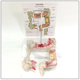 Maxbell Human Colon Model Realistic Colon Pathology Model for Lab Training Classroom