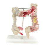 Maxbell Human Colon Model Realistic Colon Pathology Model for Lab Training Classroom