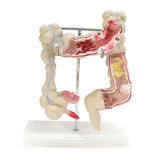 Maxbell Human Colon Model Realistic Colon Pathology Model for Lab Training Classroom