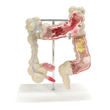 Maxbell Human Colon Model Realistic Colon Pathology Model for Lab Training Classroom