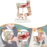 Maxbell Human Colon Model Realistic Colon Pathology Model for Lab Training Classroom