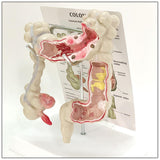 Maxbell Human Colon Model Realistic Colon Pathology Model for Lab Training Classroom
