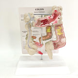 Maxbell Human Colon Model Realistic Colon Pathology Model for Lab Training Classroom