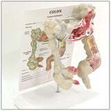 Maxbell Human Colon Model Realistic Colon Pathology Model for Lab Training Classroom