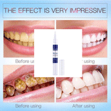 Maxbell Maxbell 1 Pcs Teeth Whitening Pen Whitener Cleaning Bleaching Stains Remover