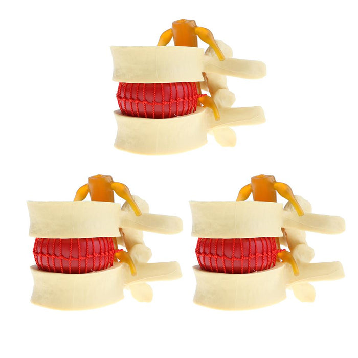 Maxbell 3X Human Spine Lumbar Intervertebral Disc Protrusion Model Magnification 2x