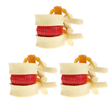 Maxbell 3X Human Spine Lumbar Intervertebral Disc Protrusion Model Magnification 2x