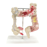 Maxbell Human Colon Model Realistic Colon Pathology Model for Lab Training Classroom