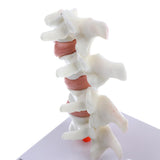 1:1 Human Lumbar Vertebra Thighbone Osteoporosis Pathology Model Kits School Teaching Display - Aladdin Shoppers