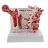 1:1 Human Lumbar Vertebra Thighbone Osteoporosis Pathology Model Kits School Teaching Display - Aladdin Shoppers