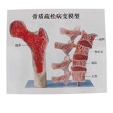 1:1 Human Lumbar Vertebra Thighbone Osteoporosis Pathology Model Kits School Teaching Display - Aladdin Shoppers