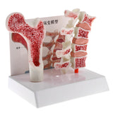 1:1 Human Lumbar Vertebra Thighbone Osteoporosis Pathology Model Kits School Teaching Display - Aladdin Shoppers