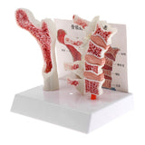 1:1 Human Lumbar Vertebra Thighbone Osteoporosis Pathology Model Kits School Teaching Display - Aladdin Shoppers