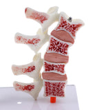 1:1 Human Lumbar Vertebra Thighbone Osteoporosis Pathology Model Kits School Teaching Display - Aladdin Shoppers