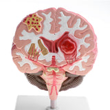 Maxbell Minification 1X Human Brain Brainstem Cerebral Hemorrhage Diseased Pathological Model Teaching Model