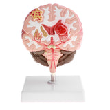 Maxbell Minification 1X Human Brain Brainstem Cerebral Hemorrhage Diseased Pathological Model Teaching Model