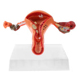 Maxbell 1:1 Human Female Uterus Ovary Pathological +Normal Model Anatomical Study