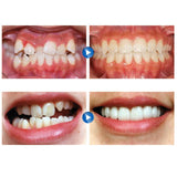 Maxbell Dental Mouth Guard for Grinding Teeth Tooth Protector Night Guard Clear