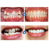 Maxbell Dental Mouth Guard for Grinding Teeth Tooth Protector Night Guard Purple