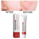 Maxbell Freckle Cream Moisturizer Repair Cream for Melasma Dark Spots Moisturizing