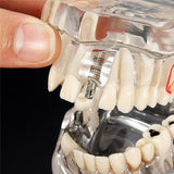 Maxbell Magnification 2x Human Mouth Dental Teeth Pathological Model Teaching Tools