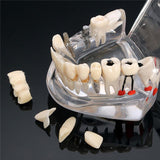 Maxbell Magnification 2x Human Mouth Dental Teeth Pathological Model Teaching Tools