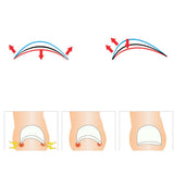 Max 100Pcs Curved Ingrown Toenail Straightening Clips Set Nail Stickers Clear