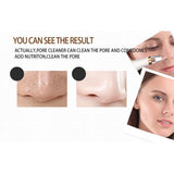 Maxbell Electric Blackhead Remover Acne Comedo Vacuum Extractor w/ 3x Suction Head
