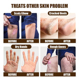 Maxbell Cracking Resistance Cream Moisturizing dry Cracking Feet Hands