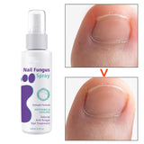 Maxbell Nail Fungal Spray Nail Care Solution for Discolored and Damaged Nails