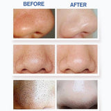 Maxbell Electric Blackhead Remover Pore Vacuum Suction Face Cleaner for Men Women