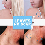 Tags&Moles Remover Device Natural Effective Scar-Free for Face Skin Care