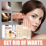 Maxbell Wart Remover 30ml Wart Removal Common Warts