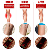 Maxbell 6pcs Vein massage varicose leg vein patch with optional pen without pen