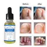Maxbell nails repair Essence Liquid Nail Fungus Treatments for Toenail Fingernail