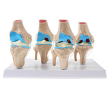 Human Pathological Knee Joint Health Lesion Comparison Skeleton Model Set Lab Equipment Educative - Aladdin Shoppers