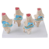 Human Pathological Knee Joint Health Lesion Comparison Skeleton Model Set Lab Equipment Educative - Aladdin Shoppers