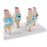 Human Pathological Knee Joint Health Lesion Comparison Skeleton Model Set Lab Equipment Educative - Aladdin Shoppers