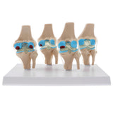 Human Pathological Knee Joint Health Lesion Comparison Skeleton Model Set Lab Equipment Educative - Aladdin Shoppers