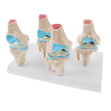 Human Pathological Knee Joint Health Lesion Comparison Skeleton Model Set Lab Equipment Educative - Aladdin Shoppers