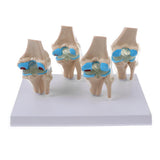 Human Pathological Knee Joint Health Lesion Comparison Skeleton Model Set Lab Equipment Educative - Aladdin Shoppers