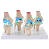 Human Pathological Knee Joint Health Lesion Comparison Skeleton Model Set Lab Equipment Educative - Aladdin Shoppers